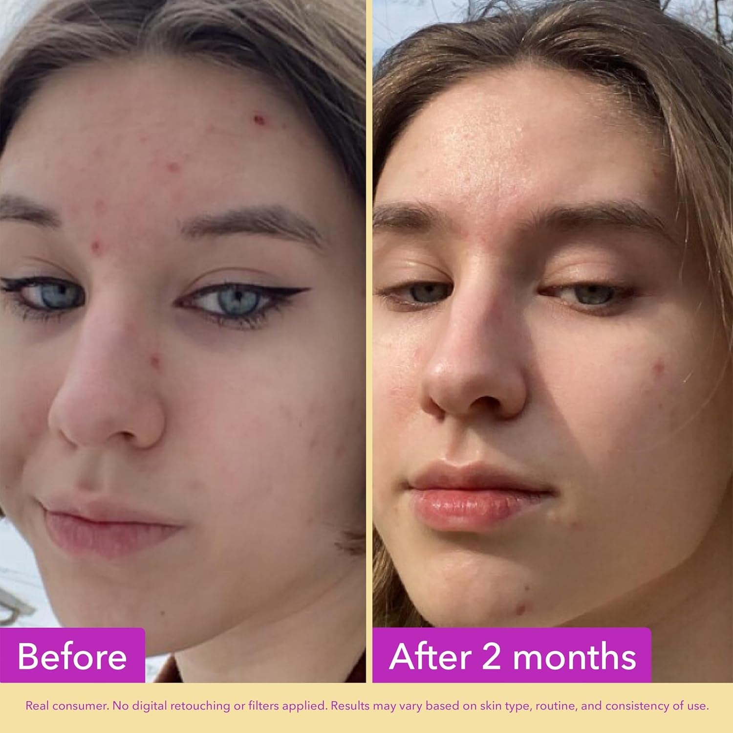 Niacinamide Serum 10%, Pore & Texture Serum, 1 Fl Oz | 10% Niacinamide Serum to Refine Skin Texture and Minimize the Look of Pores. Non-Comedogenic.
